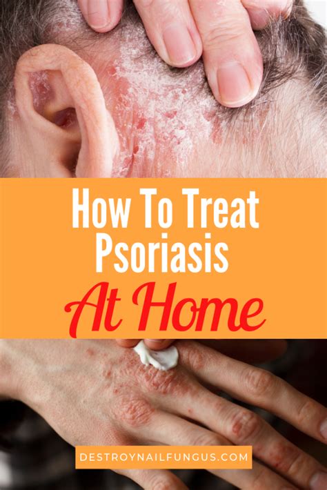 Home Remedies To Help Psoriasis