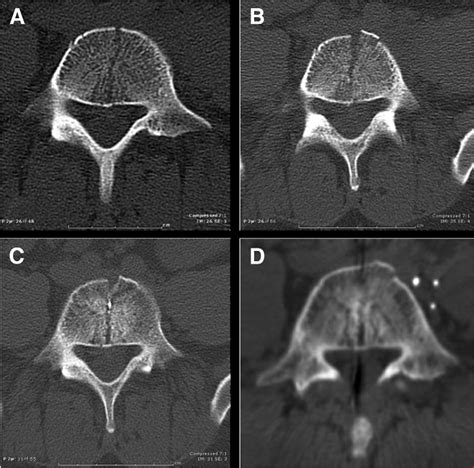 Prevention Of Vertebral Bodysplitting Fractures After Multilevel