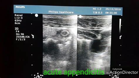 Acute Appendicitis Ultrasound Youtube