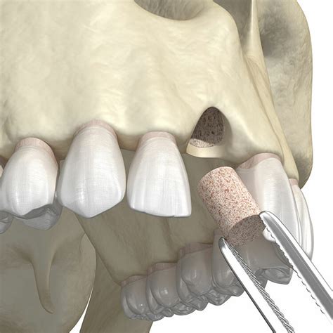 What You Need To Know About A Dental Bone Graft Main Street Dental Smiles