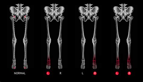 Xray Of Alignment Normal Leg Bone Or Neutral Stance Leg Bone Anterior