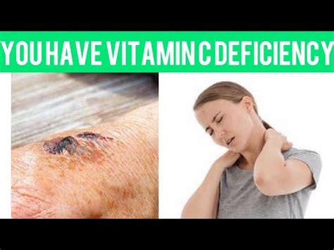 Signs And Symptoms Of Vitamin C Deficiency Youtube