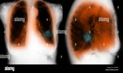 Chest X Ray Showing Copd Chronic Obstructive Pulmonary Disease And