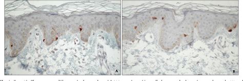 Figure 1 From Progressive Macular Hypomelanosis In Korean Patients A