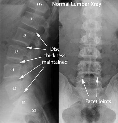 Lumbar Normal X Ray Radiology Imaging Medical Anatomy Radiology