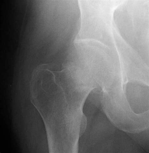 Femoral Neck Fractures Trauma Orthobullets