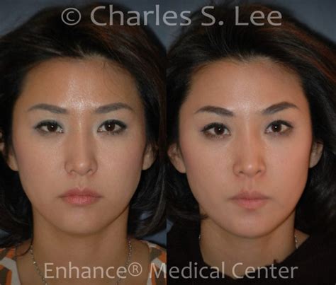 Non Surgical Browlift Midface Lift Lip Corner Lift Archives Charles