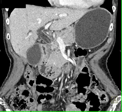 Distal Common Bile Duct Dilatation Due To Cbd Tumor Liver Case
