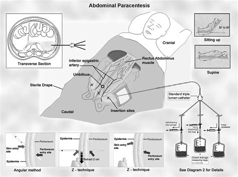 Abdominal Paracentesis And Thoracocentesis Surgical Laparoscopy