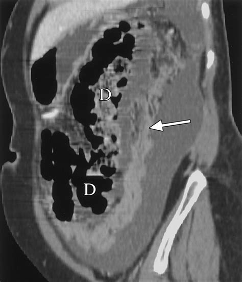 Multidetector Ct Of Peritoneal Carcinomatosis From Ovarian Cancer