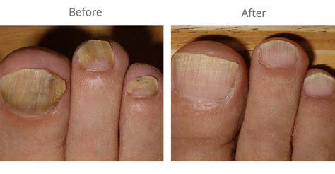 The Truth About Toenail Fungus Treatment Pure Skin Aesthetic And Laser