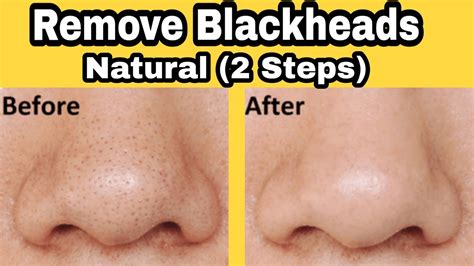 How To Remove Blackheads From Nose And Face Naturally At Home Remedies