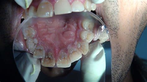 A rare presentation of multiple dens invaginatus in maxillary dentition ...