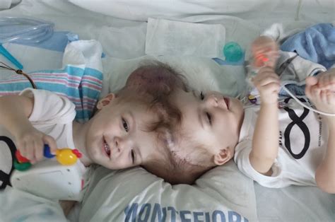 Conjoined Twin Back In Surgery After Separation Procedure