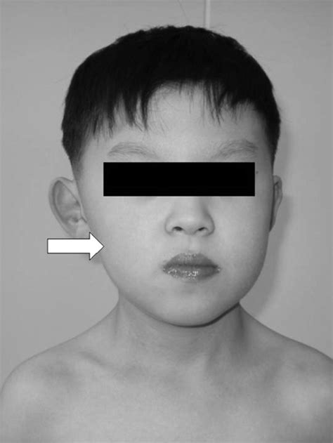 Operative Treatment Of Congenital Torticollis Bone And Joint