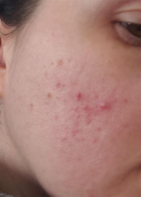 Skin Concerns Redness And Bumps Exclusively On Left Cheek R