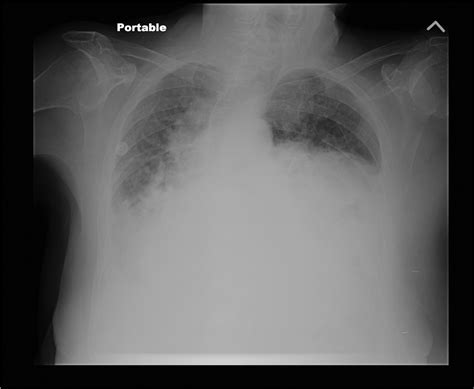 Bilateral Bochdalek Hernias Presenting As Respiratory Failure In An