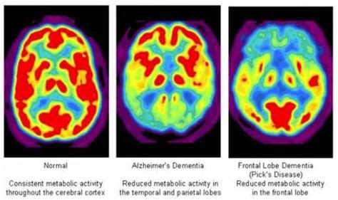 Petct In Neurology Transforming Epilepsy And Dementia Care Akumin