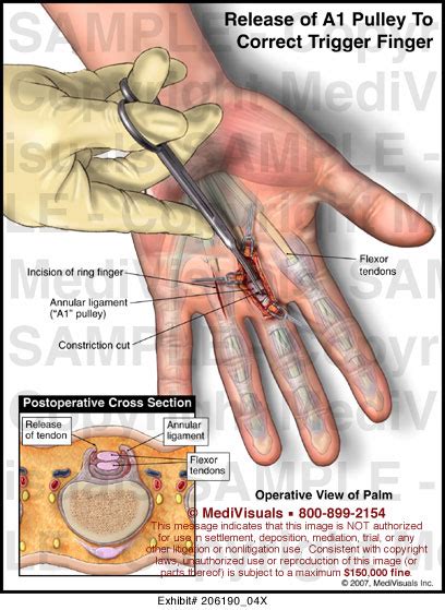 Medivisuals Release Of A1 Pulley To Correct Trigger Finger Medical