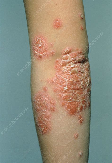 Scaly Red Psoriasis Rash On Young Womans Elbow Stock Image M240