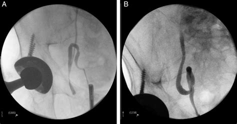 Ureteral Inguinal Hernia An Uncommon Trap For General Surgeons