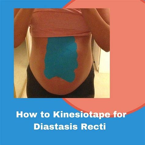 Kinesiotape Diastasis Recti In 2020 Diastasis Recti Exercises
