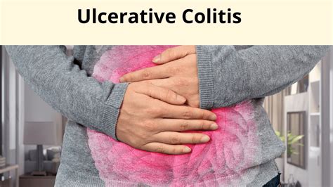 How Does Ulcerative Colitis Affect Our Life And Health Gastrology Health