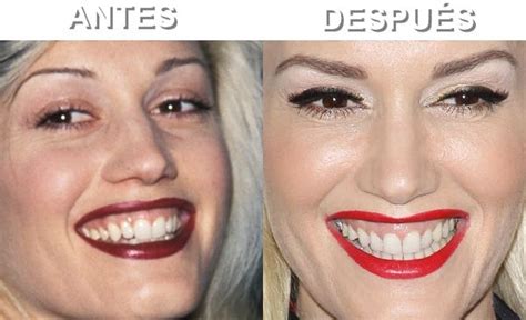 Gwen Stefani Gummy Smile