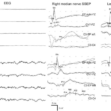 Eeg Monitoring And Somatosensory Evoked Potential Ssep Recordings