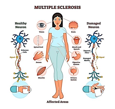 Prodrome Multiple Sclerosis