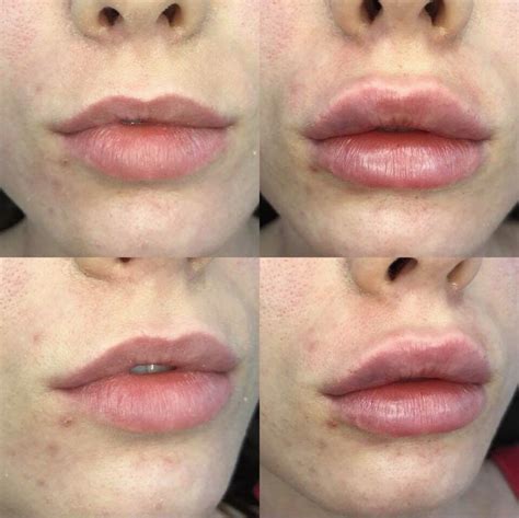 Volume Added To The Top Lip And Widening The Bottom Lip⠀ ⠀ Why Do We