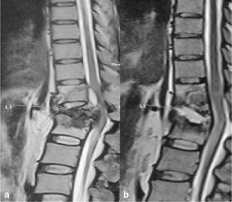 Sequential Mri Findings In A 44 Year Old Male With Potts Spine A
