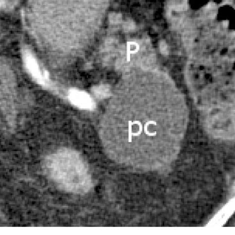 Ct Scan Performed In Patient With History Of Acute Pancreatitis Reveals