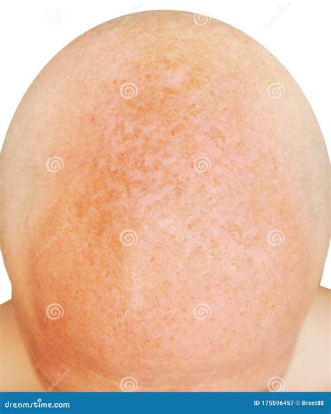 Age Spots On The Bald Head Of A Man From Sunburn Stock Image Image Of