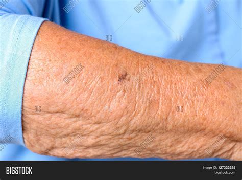 Age Spots On Forearms