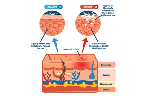 Common Causes And Triggers Of Eczema Cbdmedic™