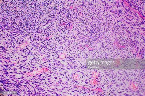 Sarcoma Photos And Premium High Res Pictures Getty Images