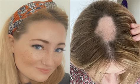 Mother Reveals She Was Left With A Bald Patch Due To Hair Loss