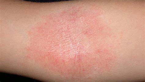 Atopic Dermatitis In Adults Pictures Photos 530