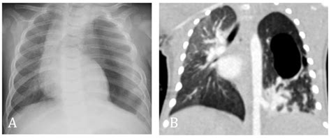 Cpam Type 1 With Congenital Ils Chest X Ray A Of The 3 Months Old