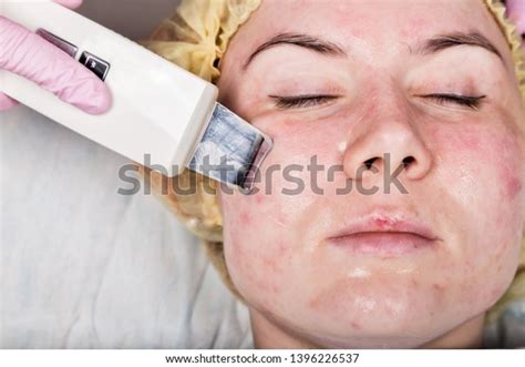 Beautician Work Ultrasonic Face Cleaning Procedure Stock Photo