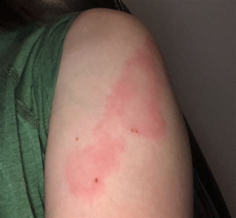 Covid Arm Rash Seen After Moderna Vaccine Annoying But Harmless