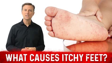 What Causes Itchy Feet And How To Stop It Drberg Youtube
