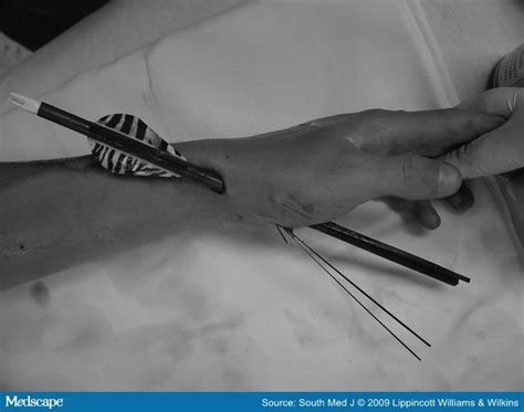 Arrow Shaft Injury Of The Wrist And Hand