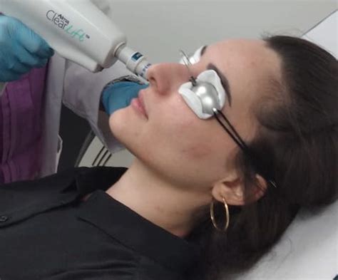 clearlift laser treatment review the beautiful lifestyle online