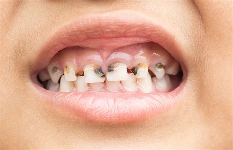 Stages Of Tooth Decay — Parkview Dental