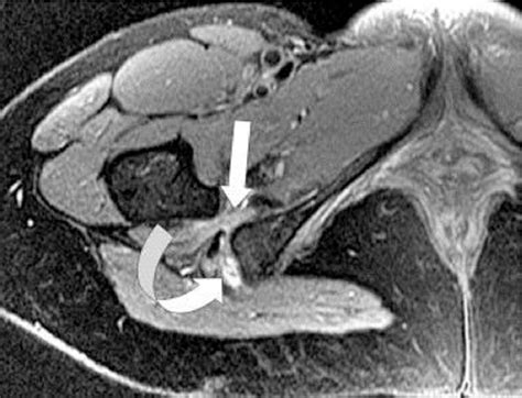 Figure 1 From Spectrum Of MRI Findings In Ischiofemoral Impingement