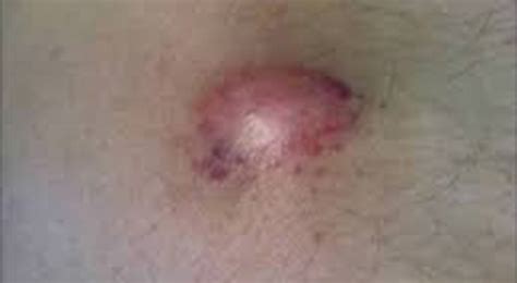 Ici, nous allons couvrir certaines des causes les plus courantes, ce qui comprend; Cancer cutané | Palli-Science : site officiel de formation ...