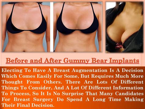 4 Reasons Why Breast Augmentation Surgery Is Becoming So Popular Artofit