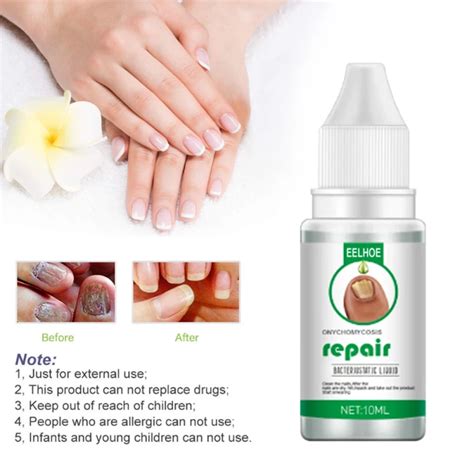 30 Ml Fungal Nail Repair Essences Serum Toe Nail Fungus Treatments Nails Gel Anti Infections